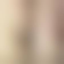 Можно ли удалять папилломы во время месячных?