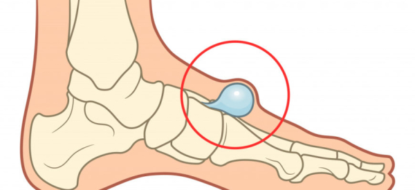 Гигрома у ребенка: причины, симптомы, лечение