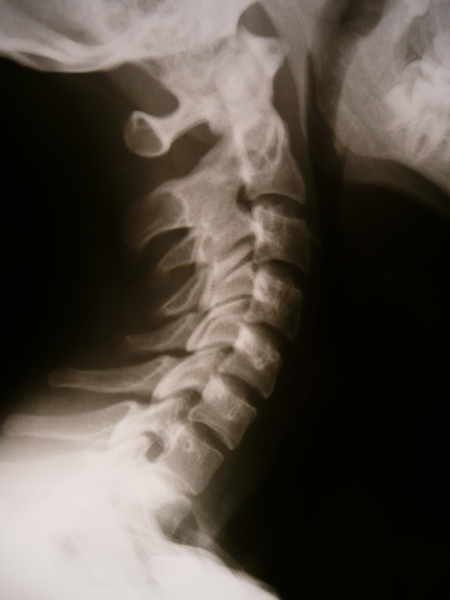 Синостоз: причины, виды, симптомы, лечение