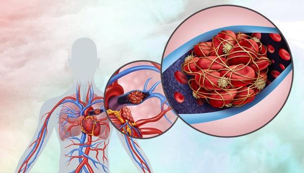 Легочная эмболия: причины, симптомы, диагностика и лечение