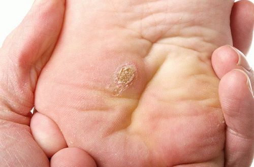 Натоптыши и подошвенные бородавки: в чем разница?