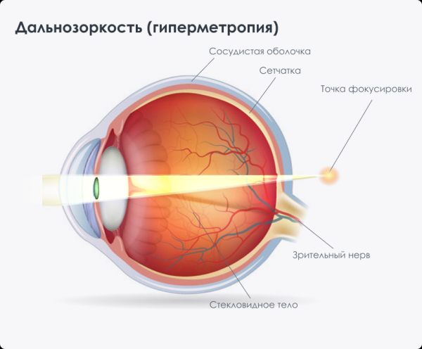 Гиперметропия у взрослых: причины и лечение дальнозоркости