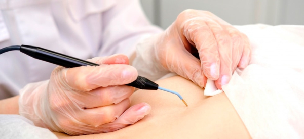 Уход за раной после удаления папилломы радиоволновым методом