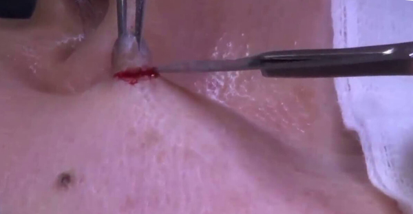 Как избавиться от бородавки на локте