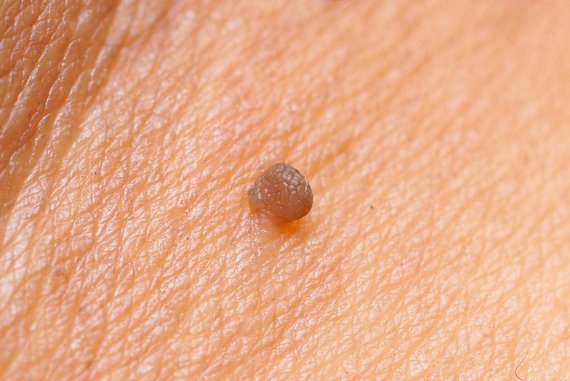 Коричневые папилломы: что это значит и как их лечить