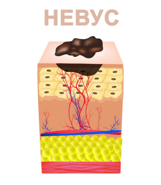 Невус и папиллома: в чем разница?
