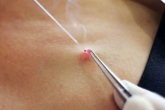 Нашатырный спирт против папиллом: особенности лечения