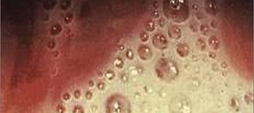 Папилломы в уретре у женщин: симптомы и лечение