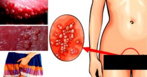 Могут ли быть бородавки во влагалище?