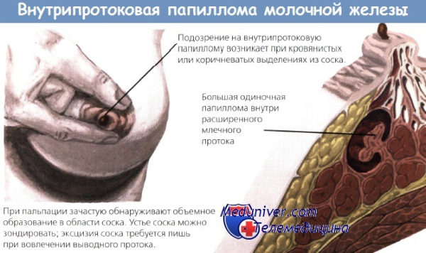 Внутрипротоковая папиллома молочной железы: симптомы и лечение