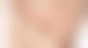 Папилломы под грудью во время беременности