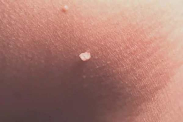 Передается ли вирус папилломы человека половым путем?