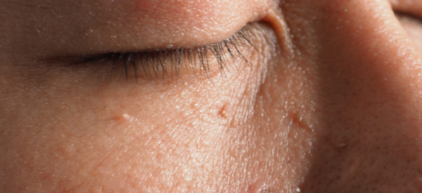 Папилломы на глазах: причины, симптомы и лечение