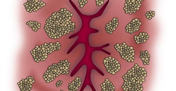 Папиллома в заднем проходе у женщин: причины и лечение