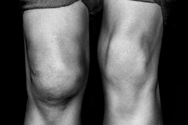 Синовит сустава: причины, симптомы, лечение, профилактика