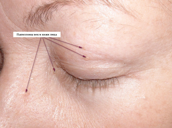 Как удалить папиллому на ножке?