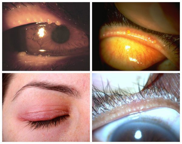 Мейбомит: причины, симптомы, лечение, профилактика