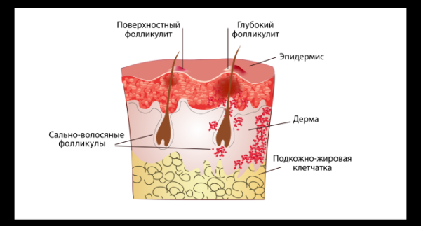 Эозинофильный фолликулит: что это такое и как лечить?