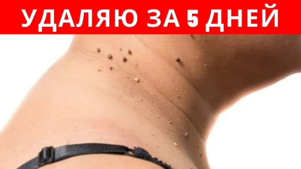 Сок алоэ от папиллом: особенности применения и противопоказания