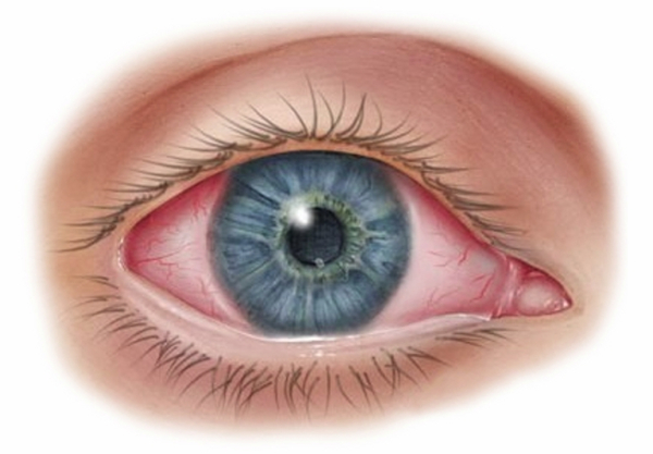 Кератоконъюнктивит: причины, симптомы, лечение, профилактика