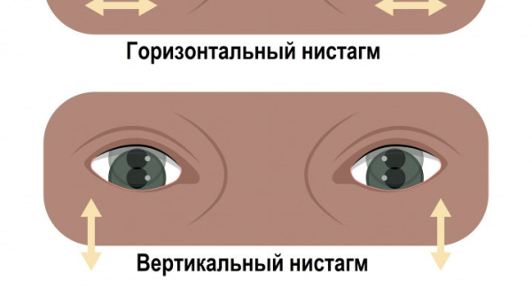 Нистагм или тремор глаз: причины, симптомы, лечение