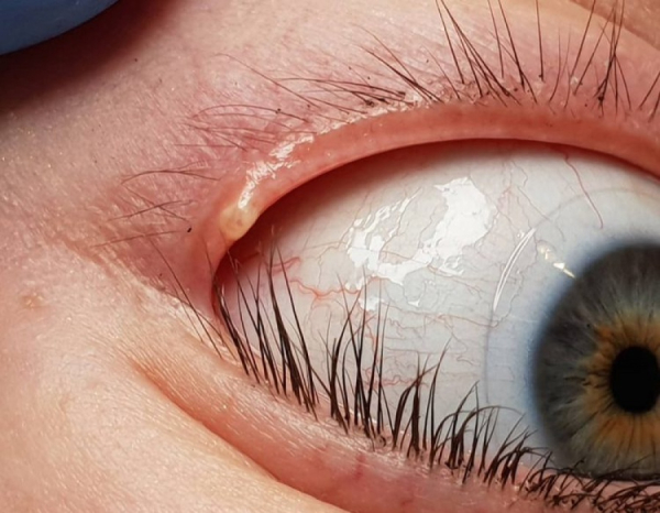 Бородавка на веке у ребенка