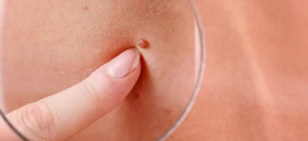 Папиллома на шее у ребенка: что делать и как лечить?