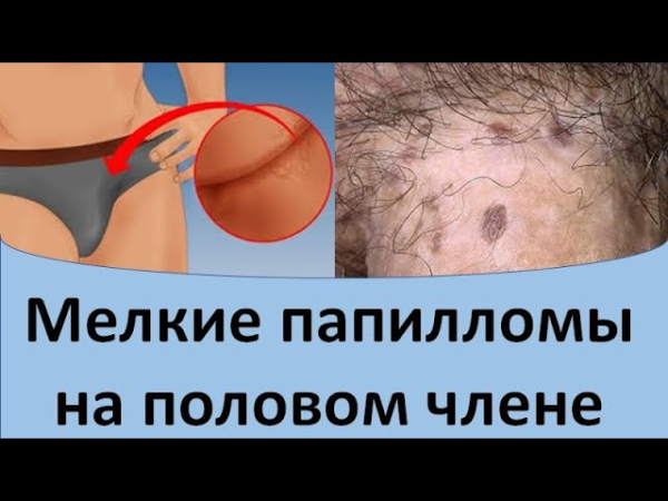 Как избавиться от папиллом на головке члена?