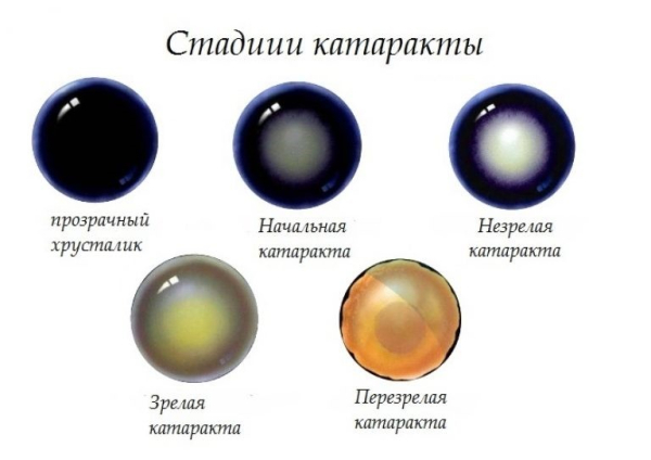 Катаракта у детей: причины, симптомы, лечение, осложнения