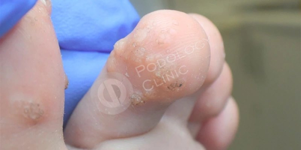 У ребенка почернела бородавка, что делать