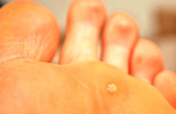 Бородавка на икре ноги: причины и лечение