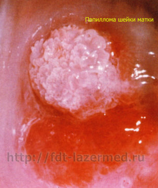 Папилломы во влагалище: симптомы и лечение