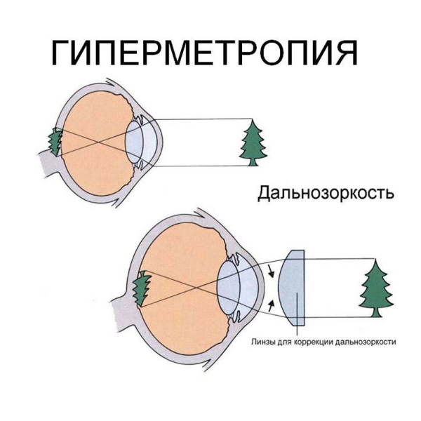 Гиперметропия у взрослых: причины и лечение дальнозоркости