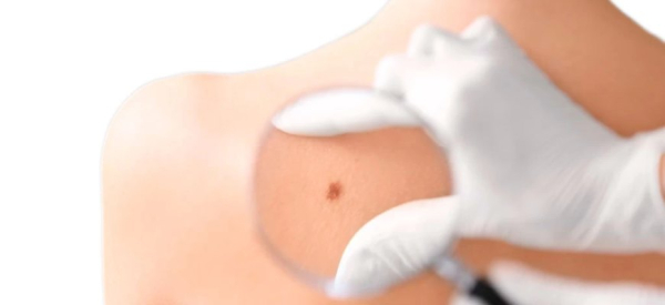 Какая методика лучше: лазерное удаление или электрокоагуляция папиллом?