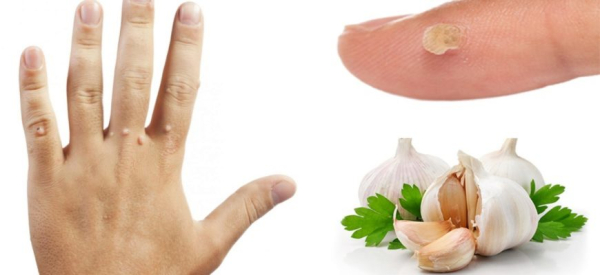 Как вылечить бородавку: рецепт с уксусом и мукой