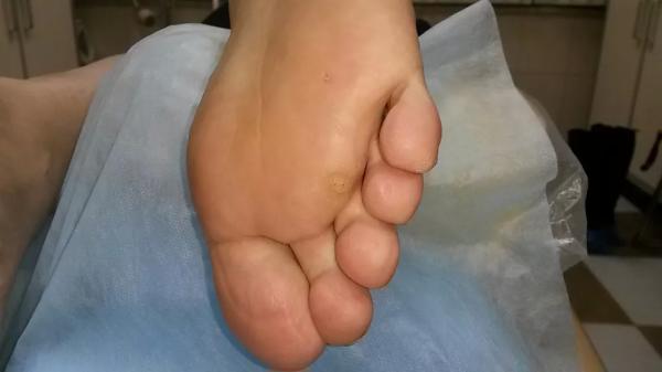 Чем отличается шипица от бородавки