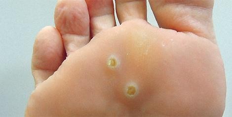 Как ликвидировать подошвенные бородавки