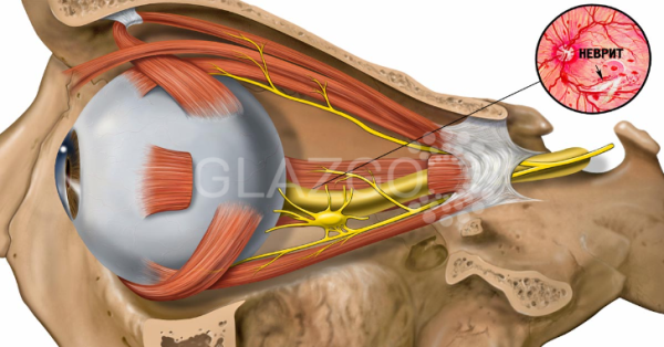 Неврит зрительного нерва: причины, симптомы, лечение