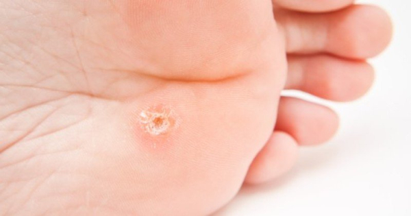 Вирусная бородавка на стопе у ребенка: причины и лечение