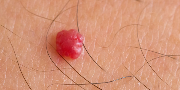 Болит папиллома, что делать?