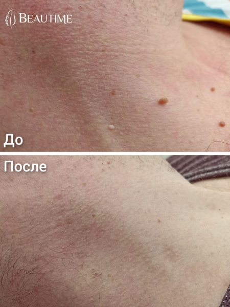 Удаление папиллом лазером: последствия и отзывы