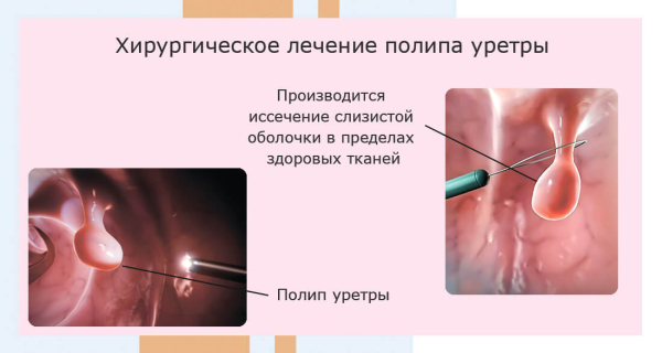 Папилломы в уретре у женщин: симптомы и лечение