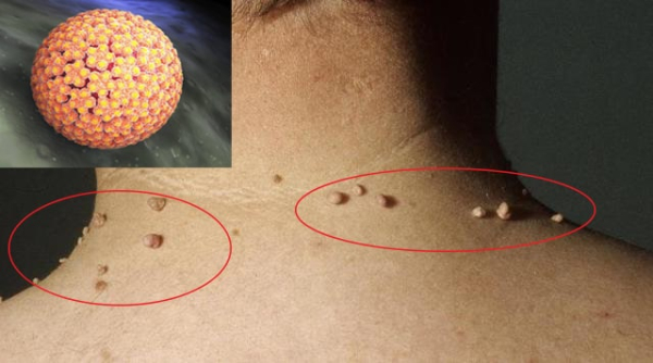 Папилломы на спине: причины и лечение