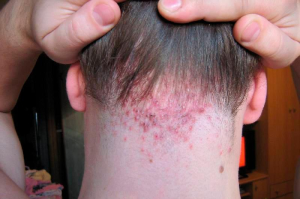 Сифилитический фолликулит: симптомы и лечение