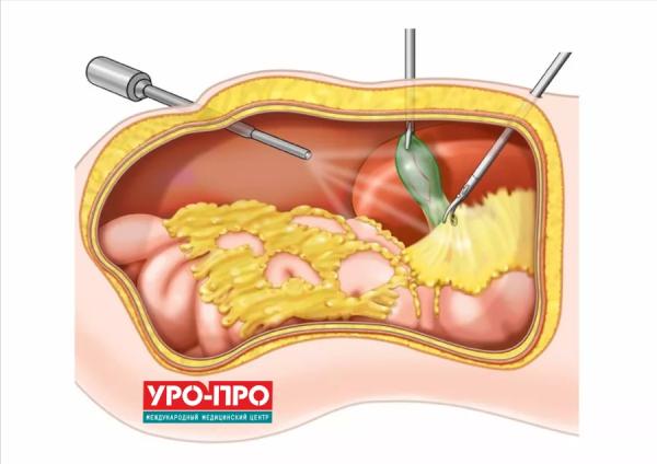 Оофорит или воспаление яичников: причины, симптомы, лечение