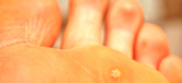 Как вылечить бородавку на стопе у ребенка