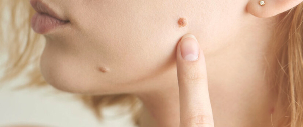 Бородавки на груди: причины и методы лечения