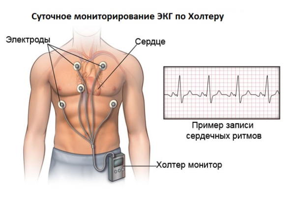 Холтеровское мониторирование (холтер-мониторинг) ЭКГ и АД: показания, проведение, цена, результат