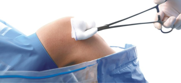 Артроскопия коленного сустава: что это такое, техника операции, отзывы