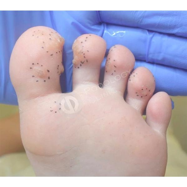 Как вылечить бородавку на стопе у ребенка